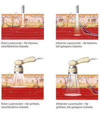 Softlaser